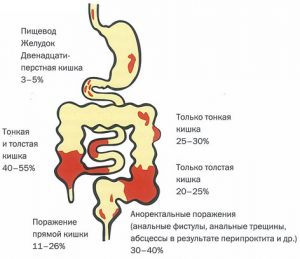 Болезнь крона у детей презентация