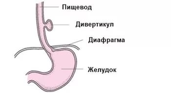 Выпячивание стенки пищевода