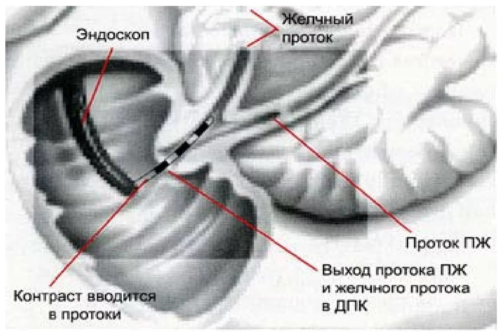 Гинекомастия у мужчин узи признаки протокол фото