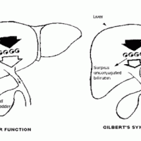 Болезнь Жильбера