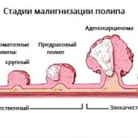 Стадии развития полипа